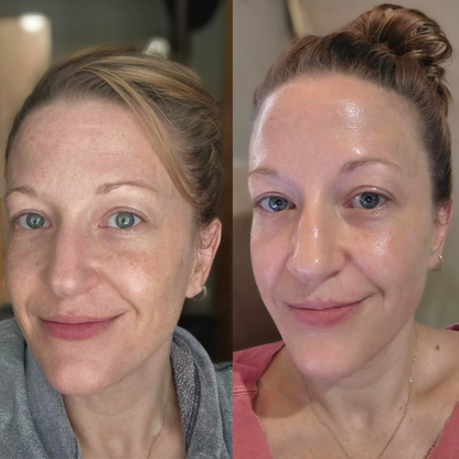 Face Peel Shot - 30ml