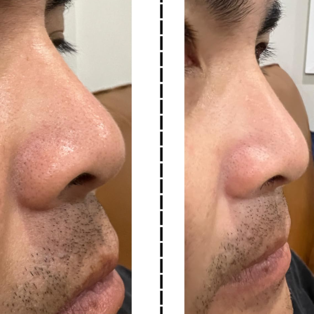 Face Peel Shot - 30ml